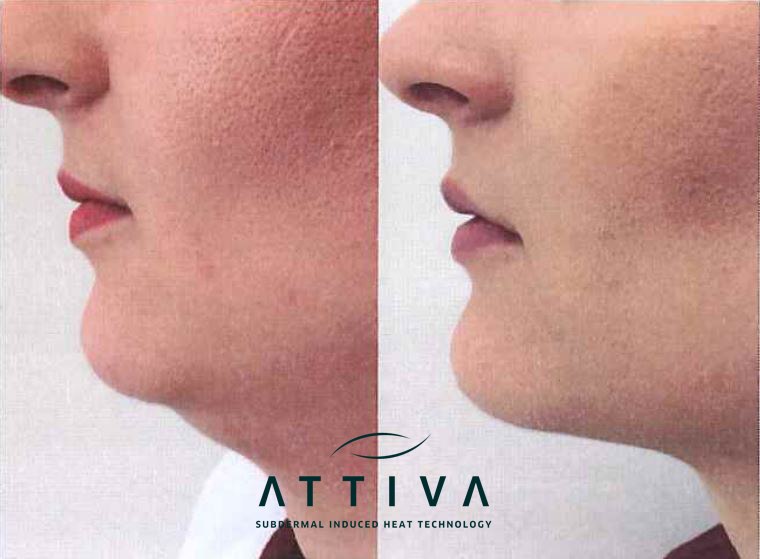 ATTIVA Chin Treatment